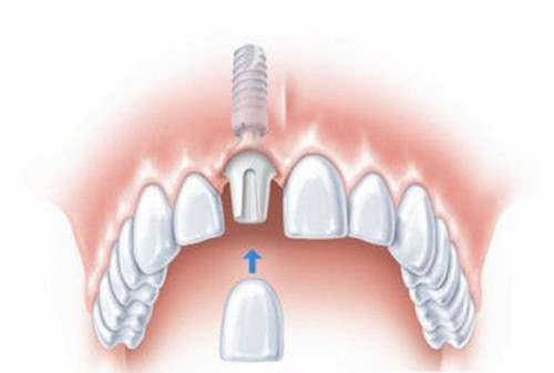 种植牙手术都有哪些流程?